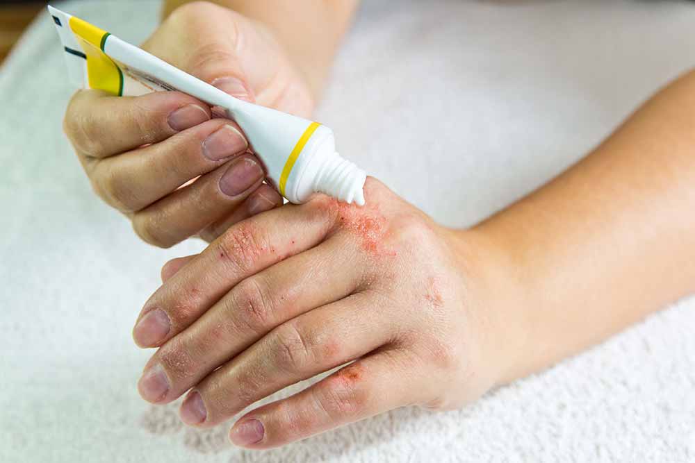 dermatitis-zdravljenje